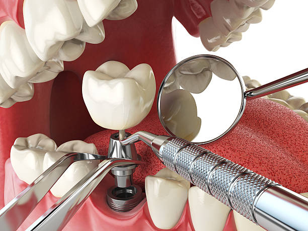 Best Emergency Root Canal Treatment in Gray, GA